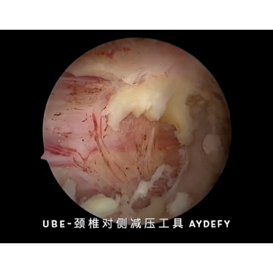 경추 UBE 수술 - 반대측 감압에 필요한 기구