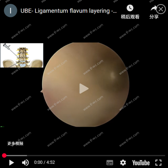 ube-ligamentum flavum layering-Corner 부위가 척추관으로 들어가 AYDEFY 수술합니다