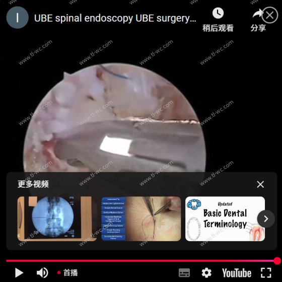 UBE脊髄内視鏡手術UBE繊維環縫合の映像です