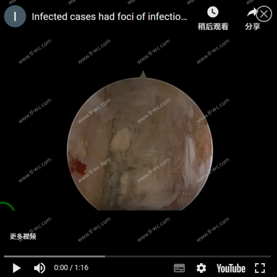 Il caso della chirurgia UBE ha un caso di infezione, 14 ververtebrali, con video che mostrano le operazioni di chirurgia a cube