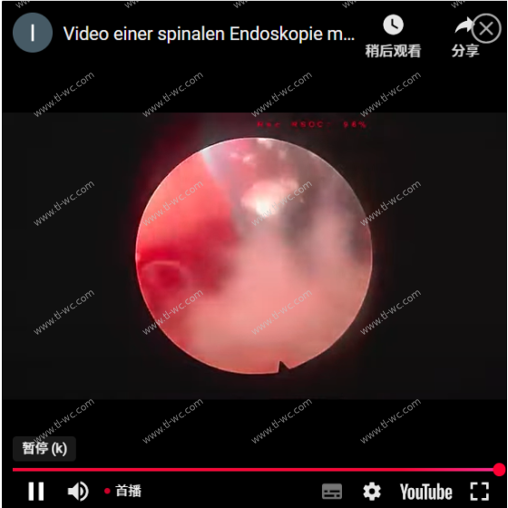 Single-portal full-process decompression video of spinal endoscopy