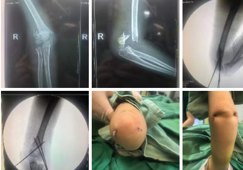 深夜急診：爲了孩子着想，我們選擇了微創手術