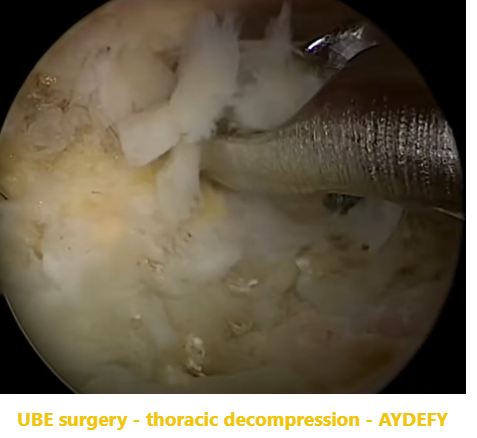 椎旁ExTLIF翻修手術下關節突的處理